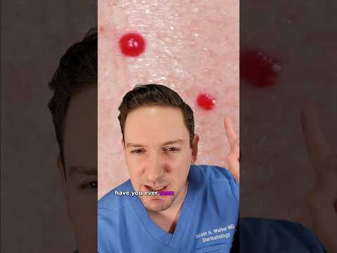 Understanding Cherry Angioma: Symptoms and Treatment Options post thumbnail image