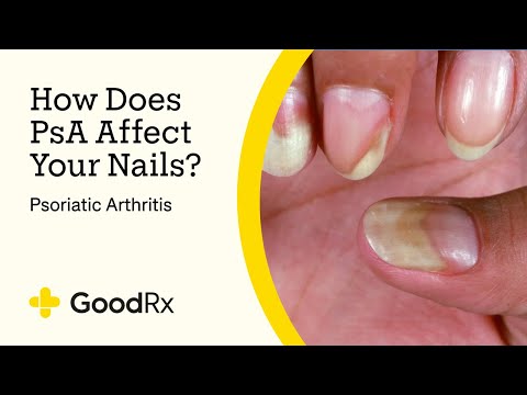 Understanding Nail Changes With Psoriatic Arthritis Symptoms