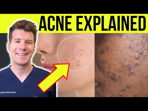 Understanding Hard Pimples: Causes and Effective Treatments