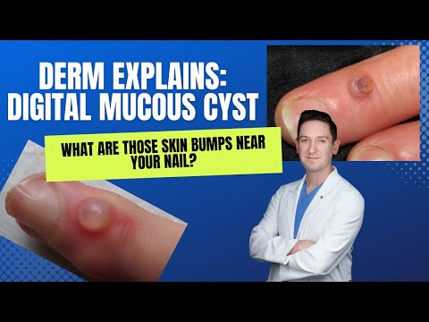 Understanding Digital Myxoid Cysts: Causes and Remedies