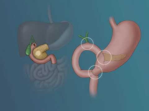 Whipple Procedure: Outcomes, Success Rates, and Insights