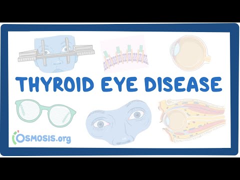 Understanding the Development of Thyroid Eye Disease