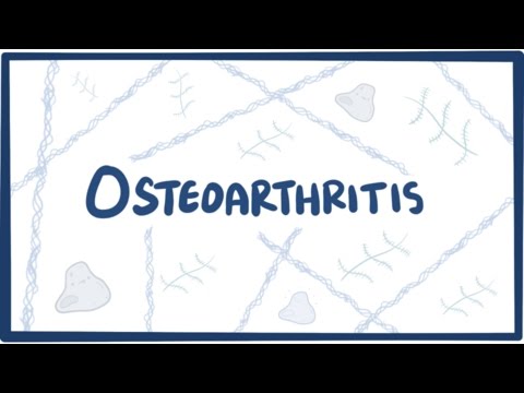 Understanding Arthritis: Symptoms, Causes, and Effective Treatment