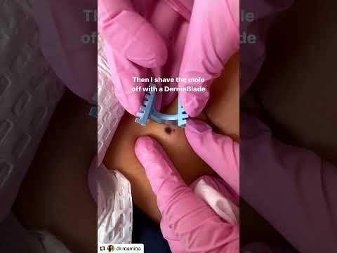 Mole Removal Insights: Scars, Care, and What to Expect