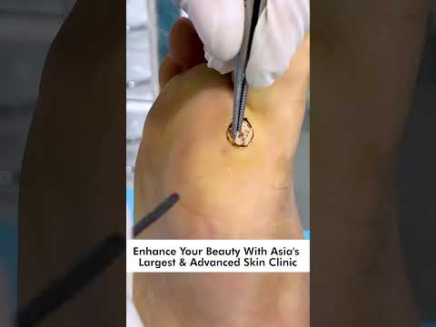 Effective Plantar Wart Treatments That Work Wonders post thumbnail image