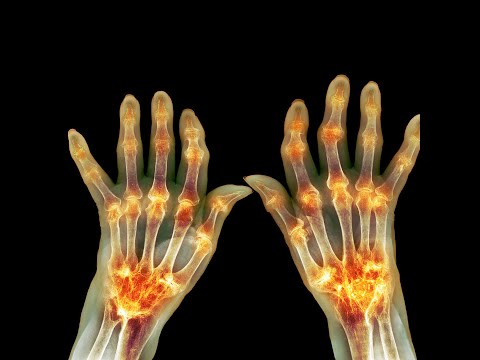 Understanding Rheumatoid Arthritis Diagnosis and Its Impact