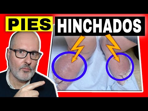 Pies hinchados: 13 Causas y Tratamientos Efectivos