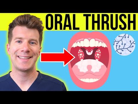 Oral Thrush: Recognize Symptoms and Find Effective Remedies