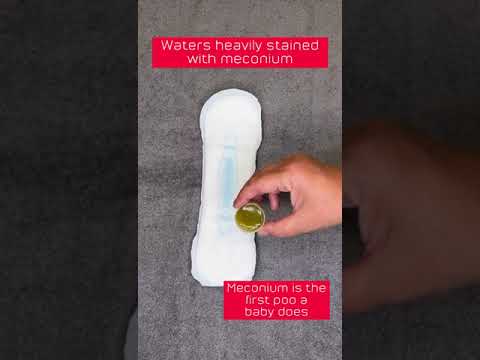 Understanding Survival Time After Your Water Breaks