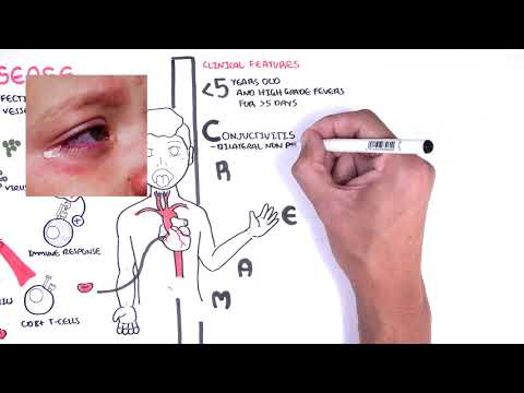 Kawasaki Disease: Understand Symptoms, Causes, and Diagnosis