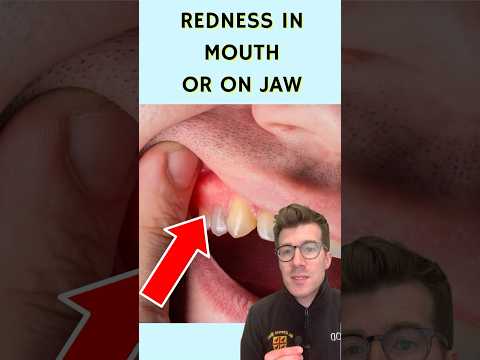 Identifying Causes of Sore Gums in the Back of Your Mouth post thumbnail image