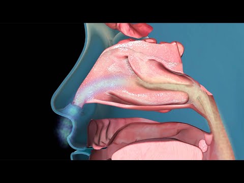 Understanding Nasopharyngitis: Key Symptoms and Treatments