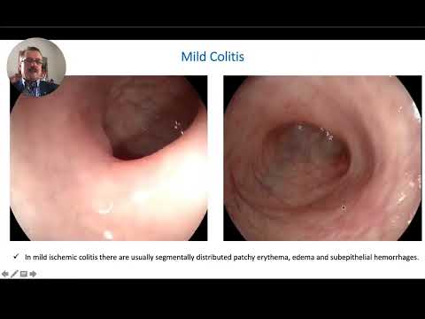Ischemic Colitis: Signs, Triggers, and Care Options