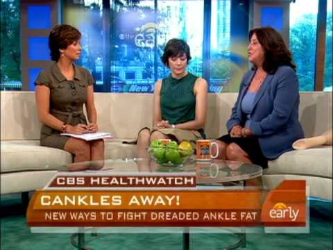 Cankles 101: Facts, Exercises, and Surgical Options