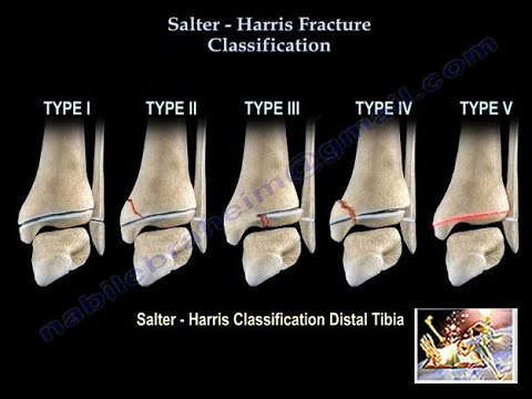 Understanding Salter-Harris Fractures: Symptoms and Types