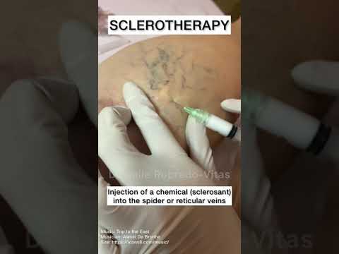 Revitalize Your Legs: Sclerotherapy for Vein Relief