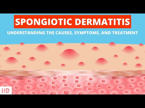 Understanding Cercarial Dermatitis: Symptoms and Care Strategies post thumbnail image
