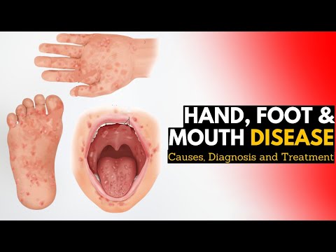 Recognizing and Treating Hand, Foot, and Mouth Disease