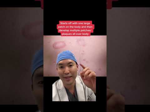 Can Your Diet Impact Pityriasis Rosea Symptoms?