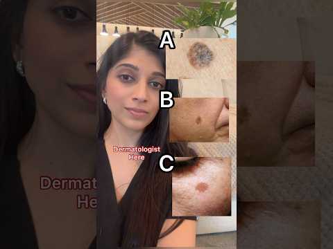 Recognizing and Treating Lentigo Maligna Melanoma Effectively