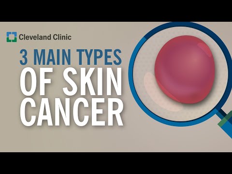 Skin Cancer: Types, Survival Rates, and What You Should Know