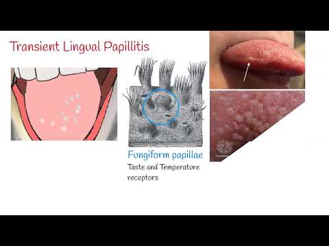 Transient Lingual Papillitis: Causes and Relief Options post thumbnail image