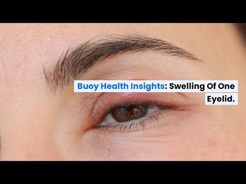 Unexpected Reasons Your Eyelid Might Be Swollen
