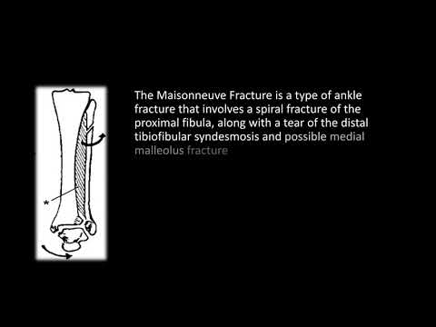 Understanding the Maisonneuve Fracture of the Ankle: Key Insights