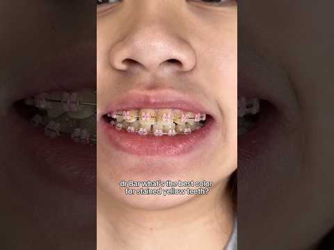 Vibrant Braces Colors: How to Pick Your Perfect Shade