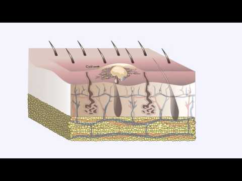 Cysts Unveiled: Types, Causes, Treatments, and Prevention