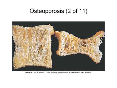 Understanding Musculoskeletal Health and Common Diseases