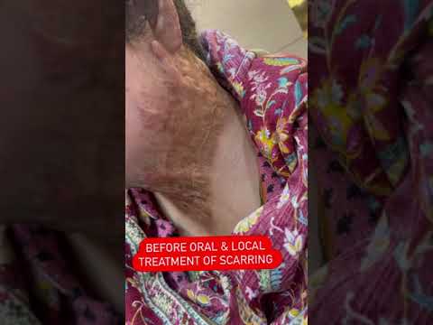Healing Burn Scars: Effective Treatments and Insights