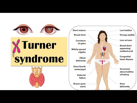Understanding Mosaic Turner Syndrome: Symptoms and Treatment Options post thumbnail image