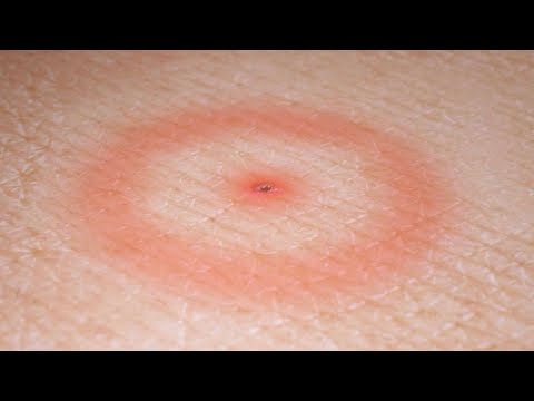 Lyme Disease: Symptoms, Causes, and Effective Treatments