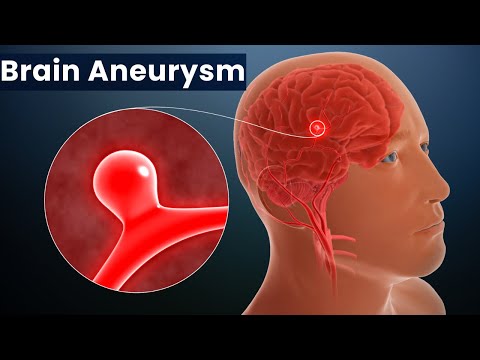 Understanding Brain Aneurysms: Signs and Causes Explained