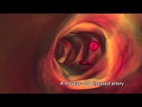 Atherosclerosis vs. Arteriosclerosis: Understanding Their Differences