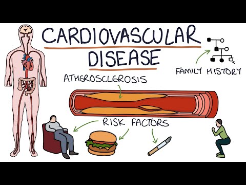 Understanding Coronary Thrombosis: Causes, Symptoms, and Care