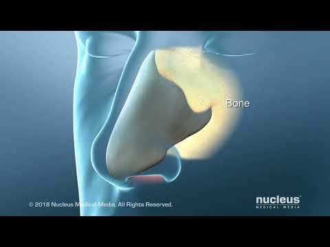 Septoplasty: What to Expect Before, During, and After Surgery