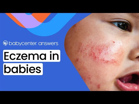 Understanding Baby Eczema: Symptoms, Causes, and Creams post thumbnail image