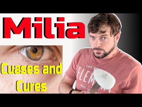 White Bumps on Your Face: Milia and Other Surprising Causes