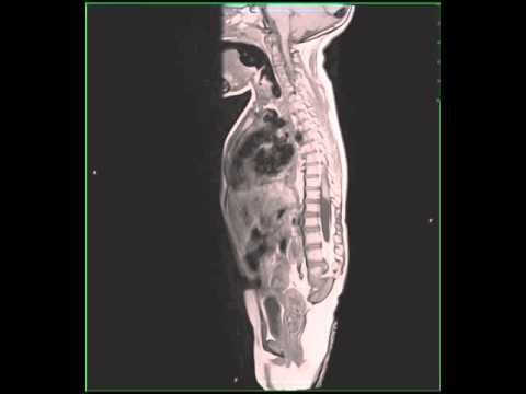 Understanding Caudal Regression Syndrome: Types and Causes