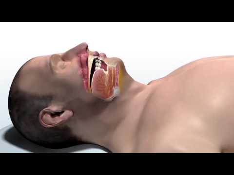 Transform Your Sleep: The Inspire Sleep Apnea Solution
