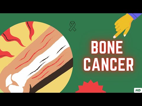 Osteosarcoma: Understanding Symptoms, Causes, and Treatment