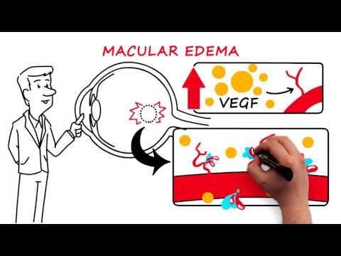 Understanding Retinal Vascular Occlusion: Symptoms and Causes