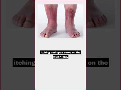 Understanding Dark Spots on Legs: Causes and Solutions