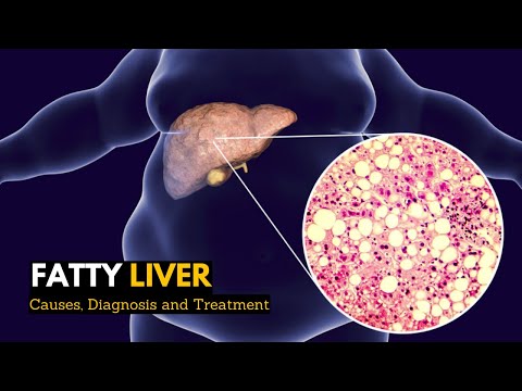 Understanding Fatty Liver: Causes, Symptoms, and Diagnosis post thumbnail image