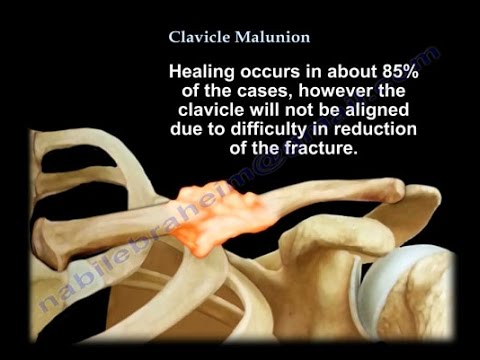 Understanding Broken Collarbone: Causes and Recovery post thumbnail image