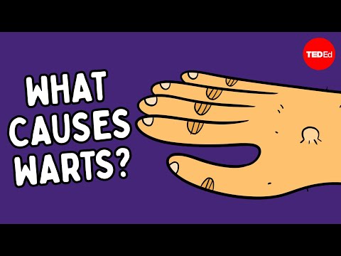 Warts: Understanding Types, Treatments, and Prevention Tips
