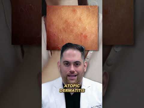 Conditions That Mimic Eczema: What to Watch For