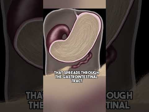 Understanding Rapunzel Syndrome: Symptoms and Treatments